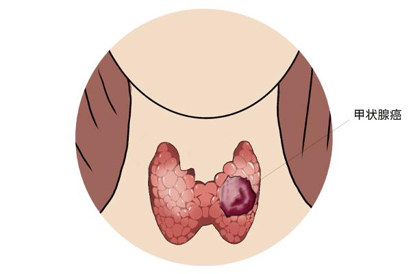 甲狀腺癌癥的主要癥狀表現有什么?為什么會得甲狀腺癌癥呢? 甲狀腺癌癥的主要癥狀表現有什么?為什么會得甲狀腺癌癥呢?